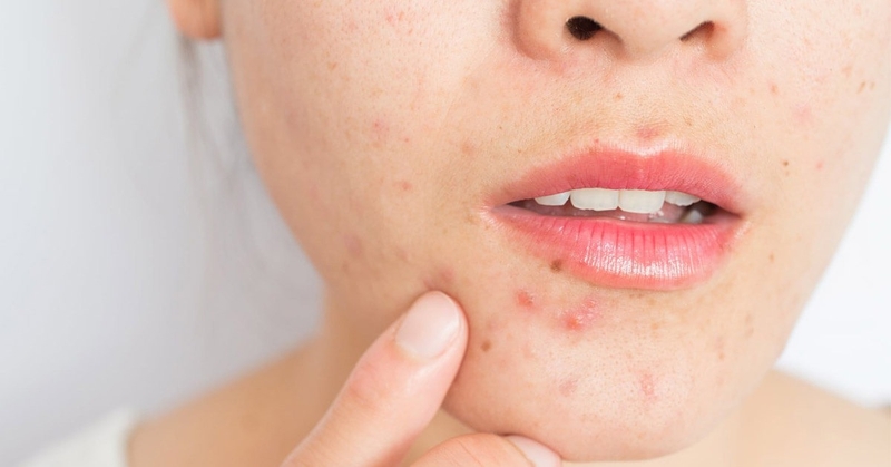 Nặn mụn đinh râu có bị méo mồm hay không?