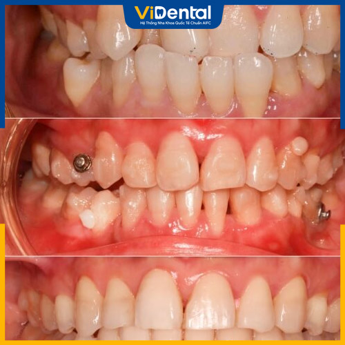 Răng mọc lệch và khấp khểnh dễ làm lệch gương mặt