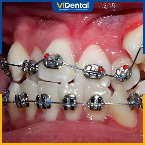 Niềng răng chỉnh nha là giải pháp phù hợp, hiệu quả cao