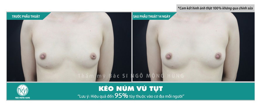 Chi phí phẫu thuật tụt núm vú