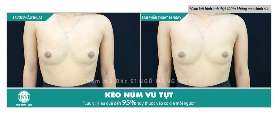 Chi phí phẫu thuật tụt núm vú