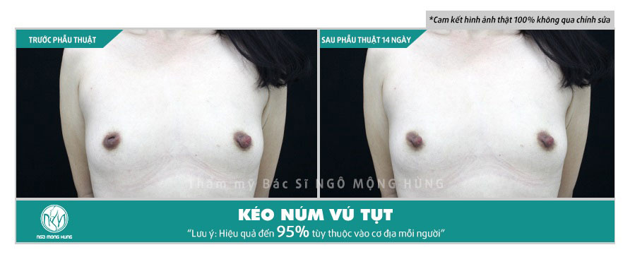 Chi phí phẫu thuật tụt núm vú