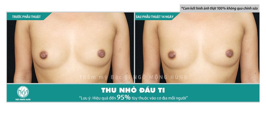 Phẫu thuật thu nhỏ núm vú ở đâu