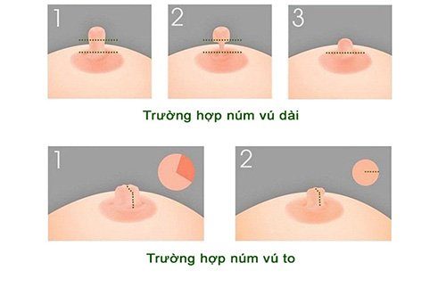 Phẫu thuật thu nhỏ núm vú ở đâu