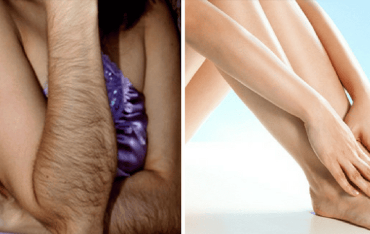 Rậm lông là một biểu hiện nồng độ testosterone ở phụ nữ cao hơn bình thường