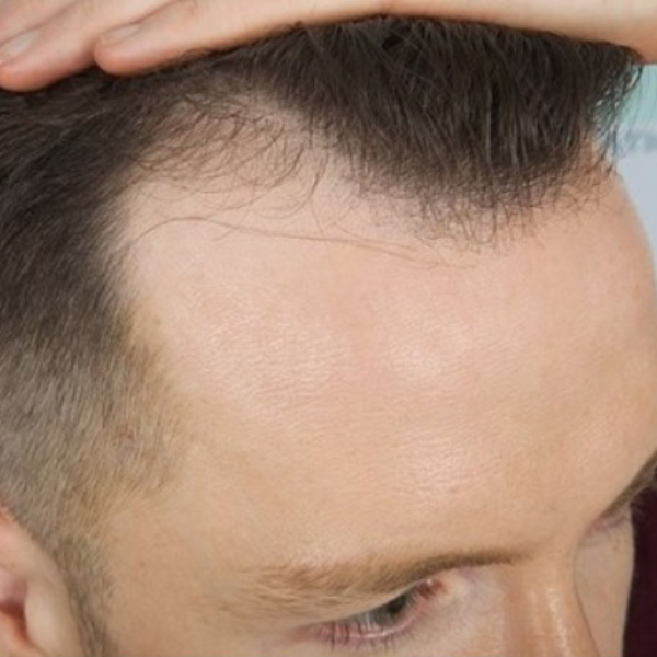 Đàn ông trán dô thường là những người điểm tĩnh và ôn hòa