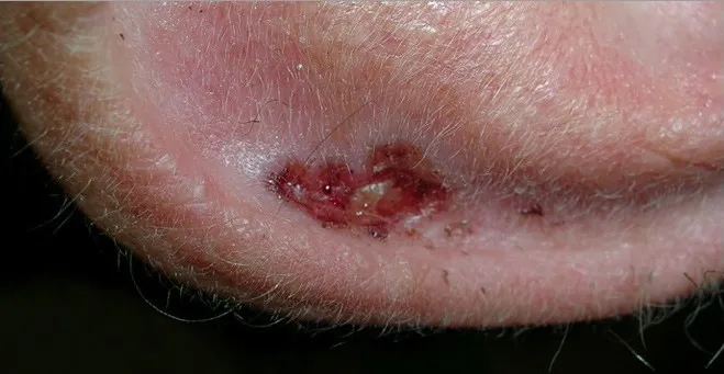 hình ảnh ung thư biểu mô tế bào đáy 4