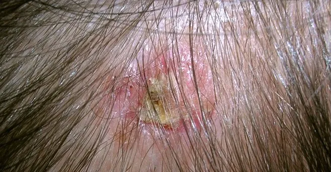 hình ảnh ung thư biểu mô tế bào đáy 5 - hình ảnh ung thư da đầu