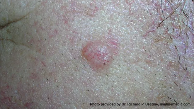 hình ảnh ung thư biểu mô tế bào đáy 8