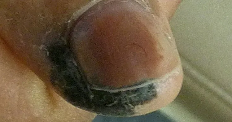 hình ảnh khối u da ác tính 3