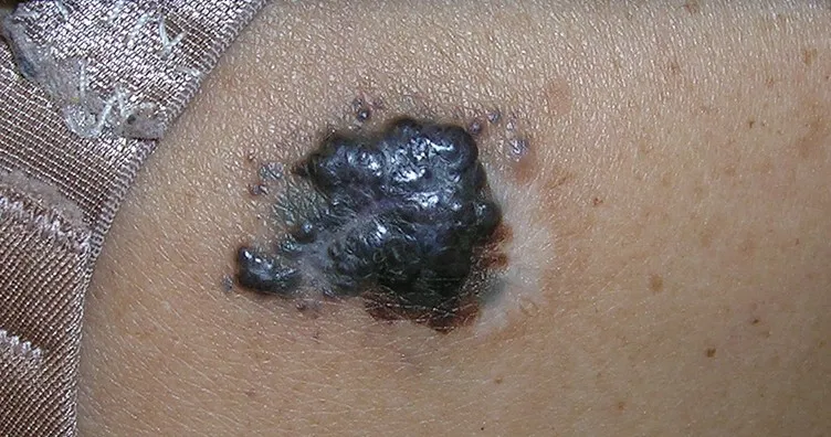 hình ảnh khối u da ác tính 5