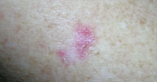 hình ảnh ung thư biểu mô tế bào đáy 2