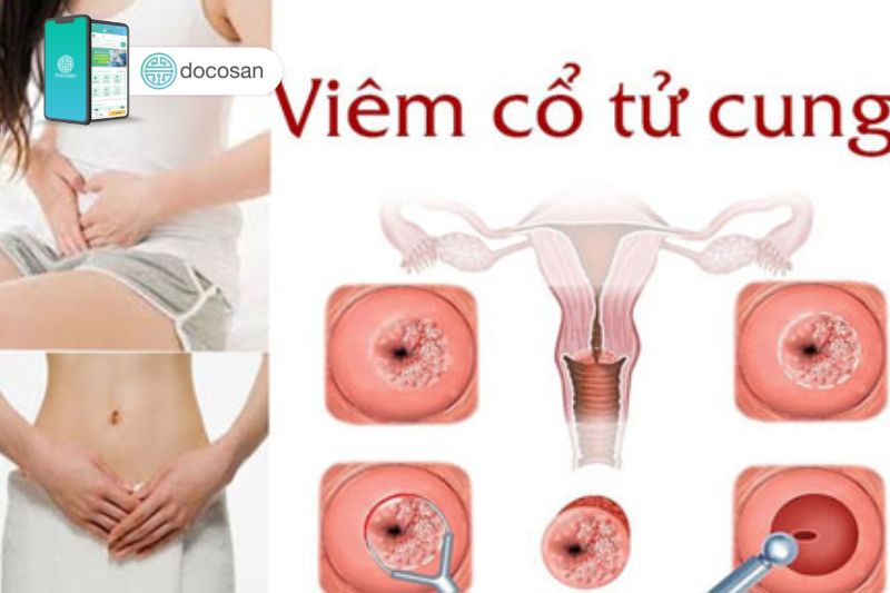 khí hư màu nâu đỏ