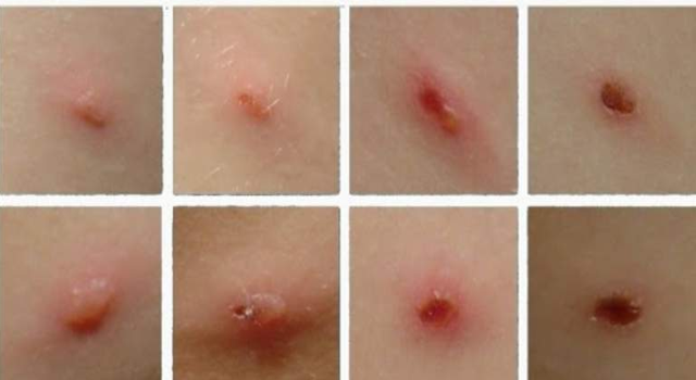 Bệnh thủy đậu lây truyền rất nhanh. Bệnh nhân có thể lây bệnh cho người khác 5 ngày trước và sau khi phát ban và không còn lây lan nữa khi các mụn nước đã khô vảy.