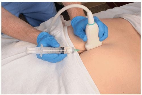 Phương pháp phong bế dẫn truyền thần kinh sử dụng thuốc gây tê cục bộ và corticosteroid được tiêm trực tiếp vào dây thần kinh xương cụt.