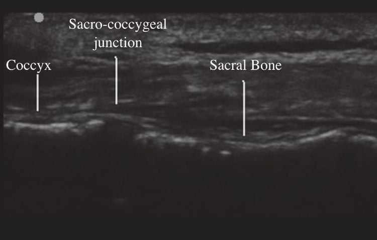 Đau xương cụt: Nguyên nhân và cách điều trị
