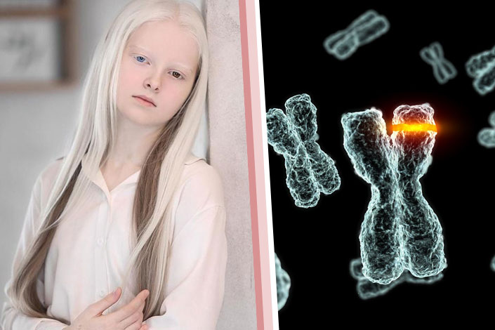 Đột biến gen gây nên bệnh bạch tạng 