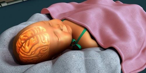 Trẻ sơ sinh sẽ bị vàng da nhân khi chất Bilirubin vượt qua giới hạn cho phép