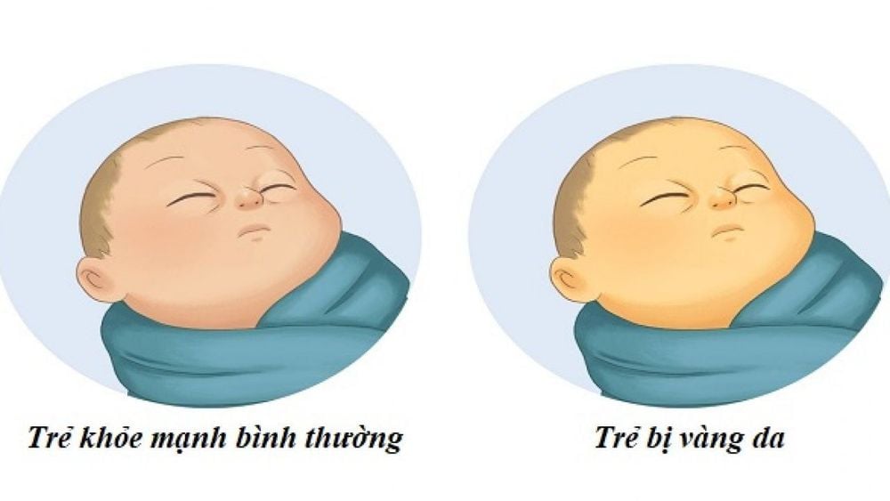 Vàng da ở trẻ sơ sinh: Dấu hiệu cảnh báo bệnh lý