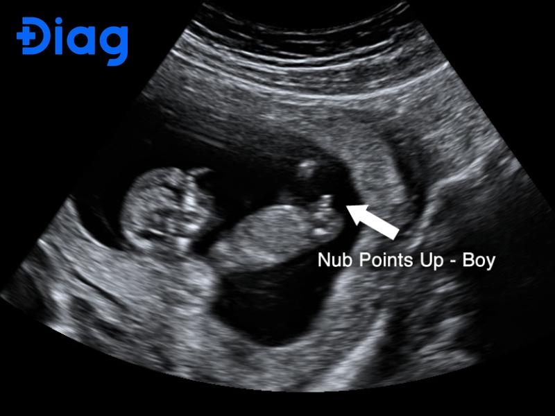 hình ảnh siêu âm con trai