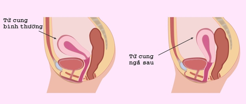Tử cung ngả sau sinh con trai hay gái? Có ảnh hưởng gì đến thai nhi không?