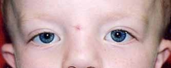 Opitz G/BBB syndrome