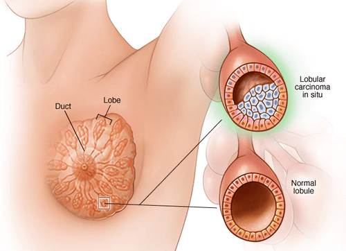Đa số ung thư vú là adenocarcinoma