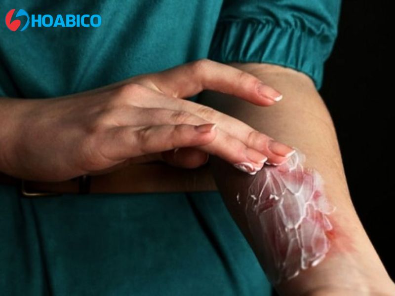 Cách sơ cứu khi vô tình tiếp xúc với NaOH