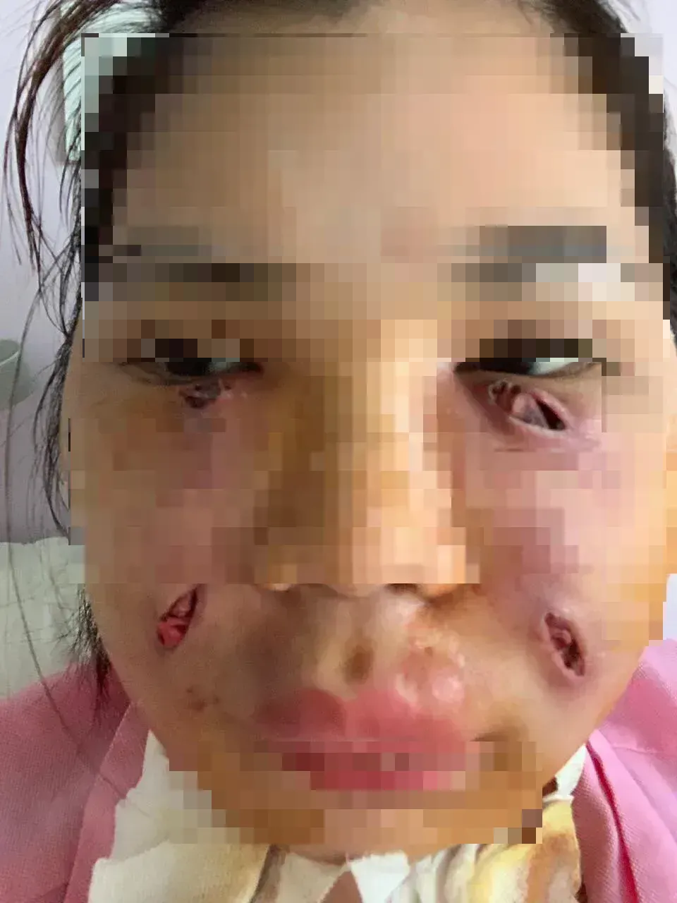 Sốc: Cô gái xinh đẹp mặt biến dạng, chi chít lỗ rò mủ sau 2 mũi tiêm mỡ tự thân - 2