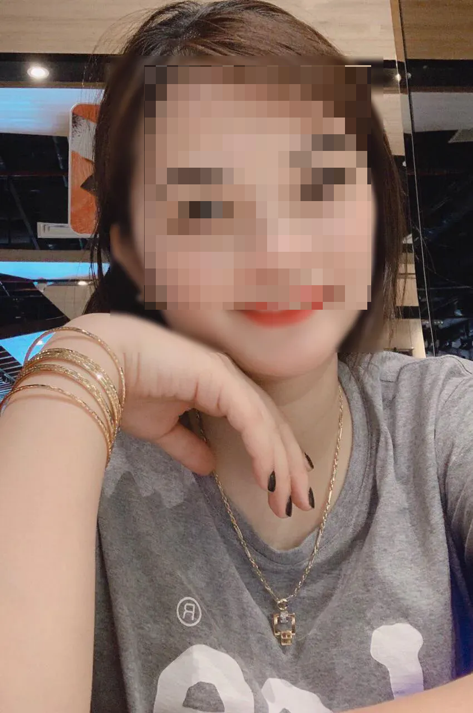 Sốc: Cô gái xinh đẹp mặt biến dạng, chi chít lỗ rò mủ sau 2 mũi tiêm mỡ tự thân - 1