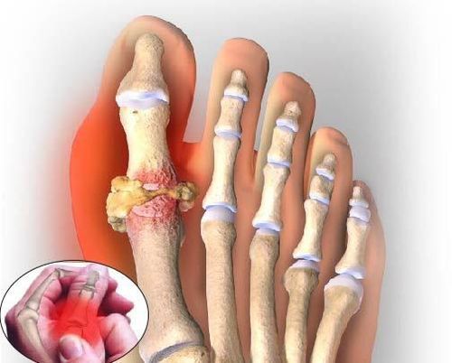 Chỉ nên sử dụng thuốc để điều trị cơn đau do bệnh gout cấp