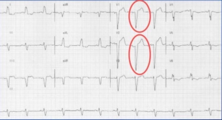 Hình ảnh nhồi máu cơ tim thành trước cấp tính
