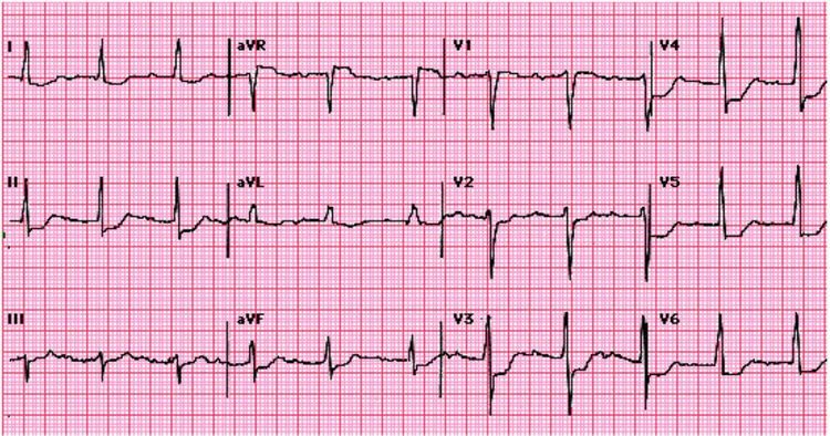 Hình ảnh nhồi máu dưới nội tâm mạc (thất trái) trên ECG
