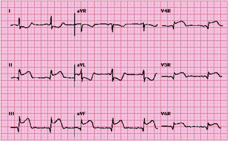 Hình ảnh nhồi máu cơ tim thất phải