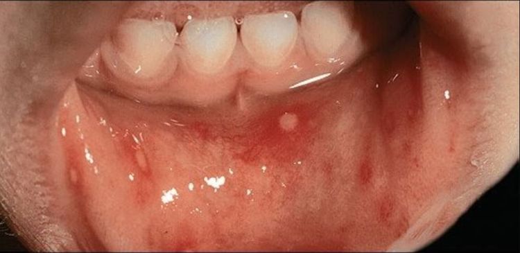 Hình ảnh bệnh tay chân miệng