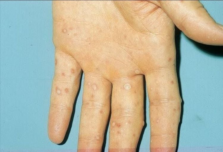 Hình ảnh bệnh tay chân miệng ở bàn tay