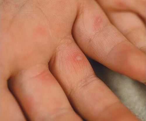 Hình ảnh bệnh tay chân miệng với các mụn nước đỏ