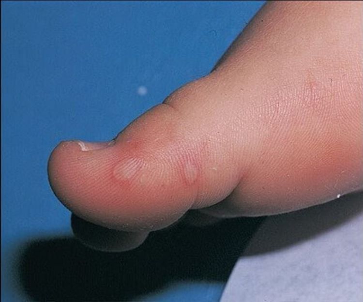 Hình ảnh bệnh tay chân miệng ở chân