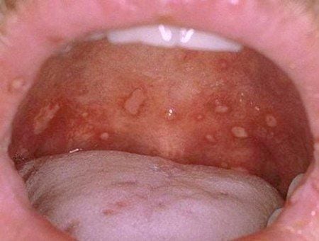 Quan sát hình ảnh bệnh tay chân miệng ở trẻ em