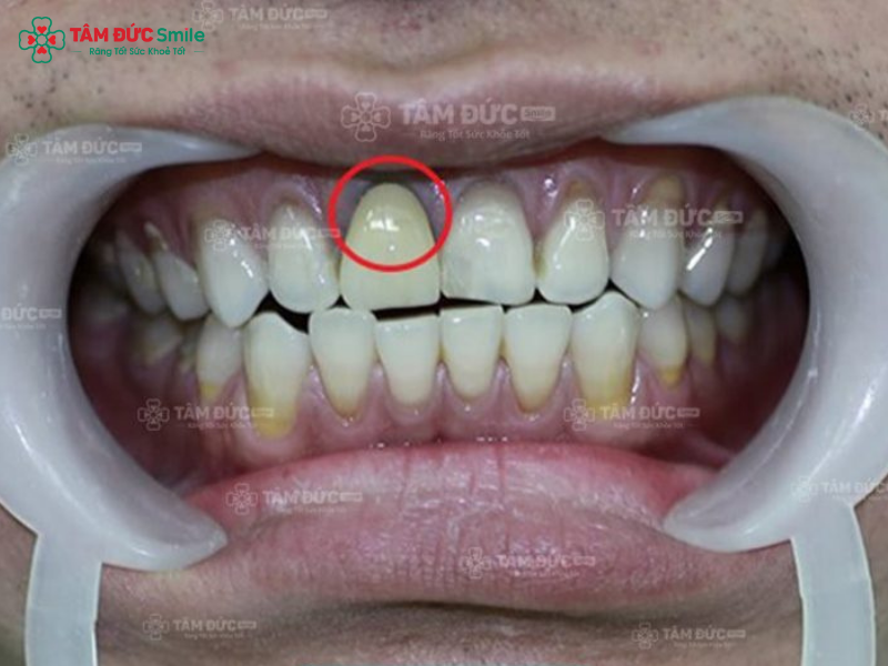 Tác hại của răng sứ kim loại: đen viền nướu, hôi miệng, dễ oxy hóa, kém bền