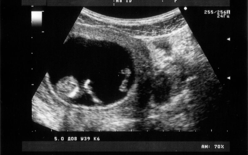 10 Dấu hiệu thai IVF đã vào tổ an toàn