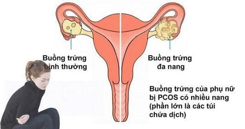 Polycystic ovary syndrome is a cause of miscarriage