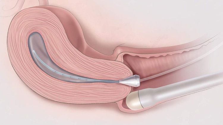 Transvaginal ultrasound gives accurate results.