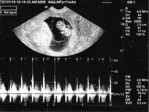 Understand Correctly About Ultrasound Results With No Fetal Heartbeat