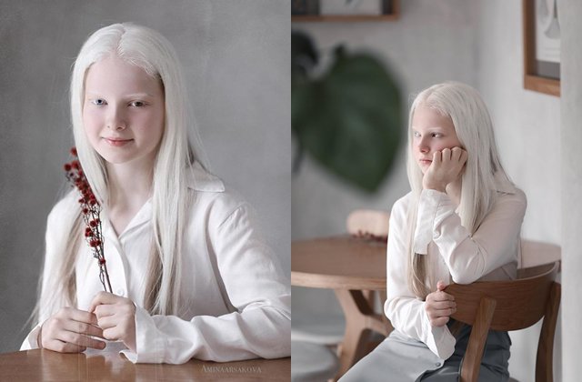 Bé gái có mắt trái xanh nước biển, mắt phải màu hổ phách, tóc 2 màu độc nhất vô nhị - 3