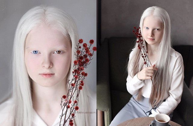 Bé gái có mắt trái xanh nước biển, mắt phải màu hổ phách, tóc 2 màu độc nhất vô nhị - 2