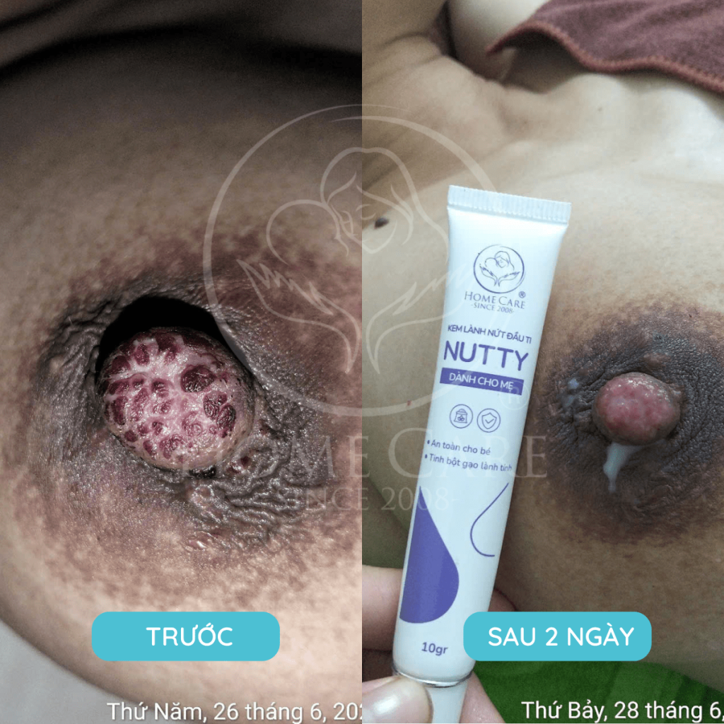 Kem-boi-nut-dau-ty-kem-boi-nut-co-ga-cho-me-Kem-Nutty-home-care (1)-min (1)