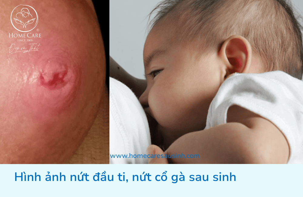 Dấu hiệu & Hình ảnh nứt cổ gà: Cách nhận biết sớm để tránh đau rát kéo dài