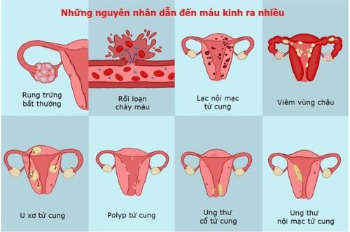 Chảy máu kinh nguyệt ồ ạt có thể bắt nguồn từ nhiều nguyên do khác nhau