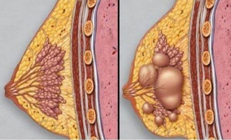 Phân biệt tắc tia sữa với áp xe vú sau sinh